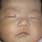 newborn and infant acne is harmless 