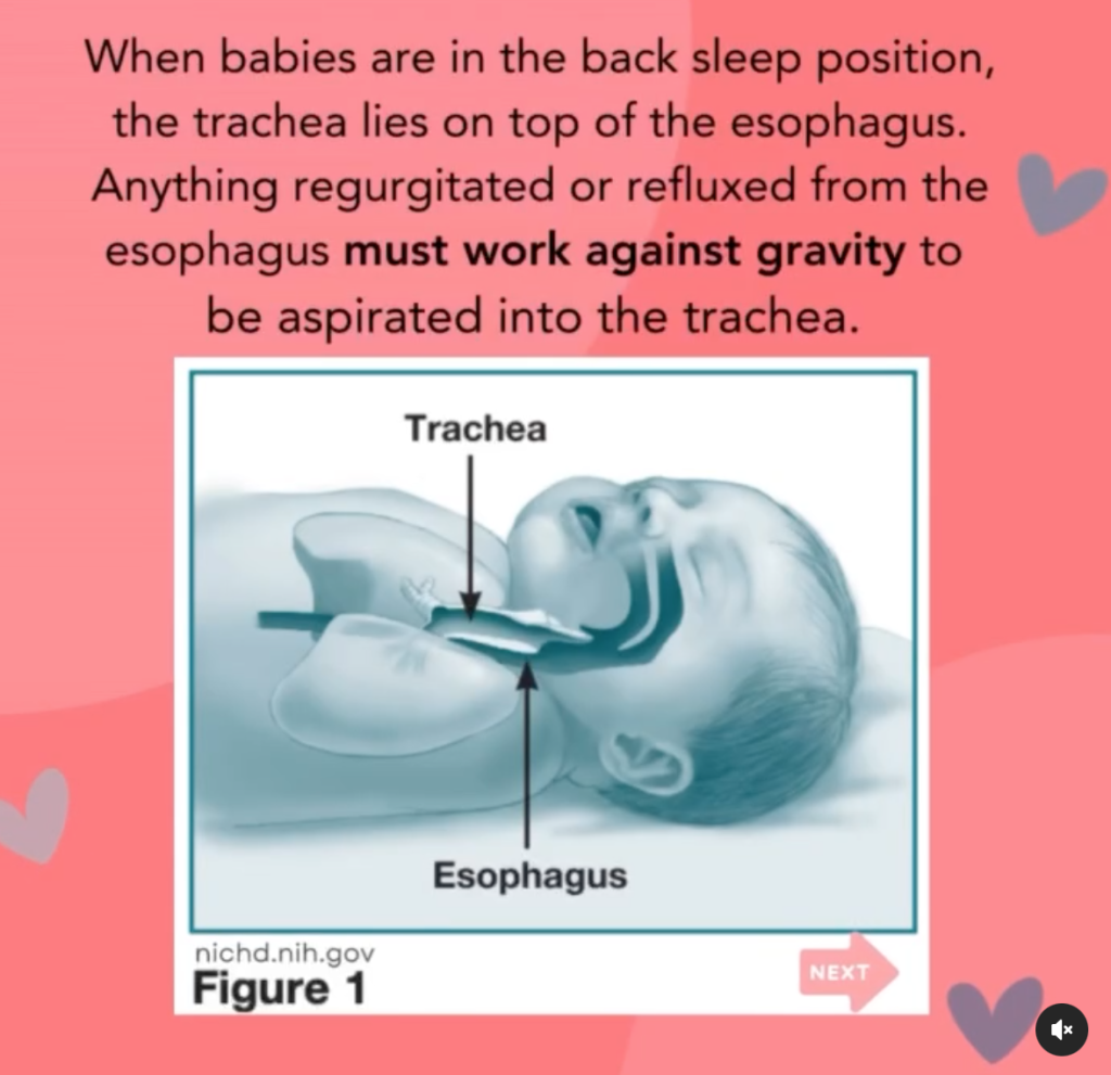 back sleeping is safest for baby, trachea and esophagus are unblocked