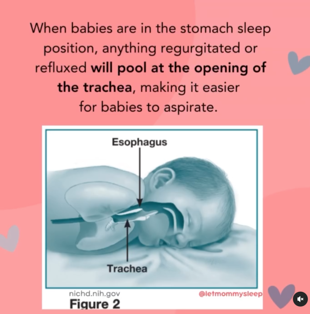 baby sleeping on stomach shows how trachea blocks the esophagus